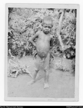 Young boy with yaws