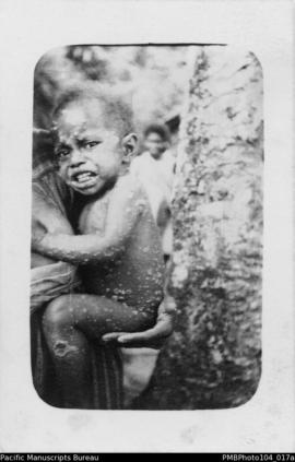 Small child with yaws